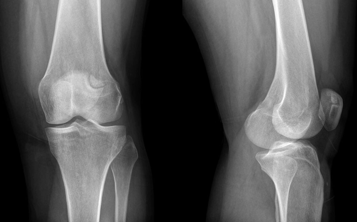 Ceļa artroze uz X -ray pirms Hondroine lietošanas