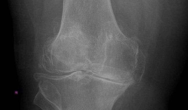 Artrozes diagnoze