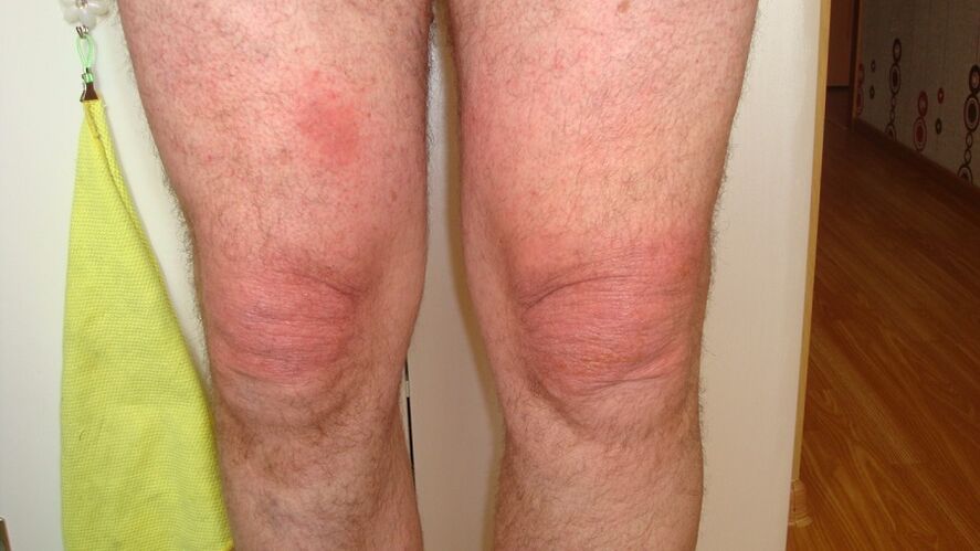 ceļa locītavu artroze